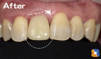 抜歯から救う再生治療　