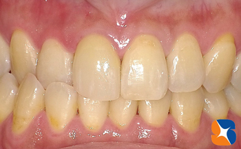 本物と見分けがつかない会心の前歯