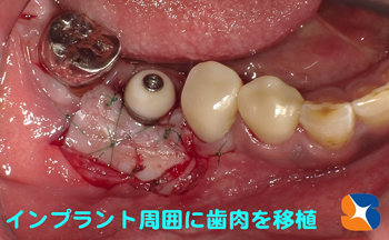 分厚い歯肉をインプラント周囲の歯肉にチェンジする