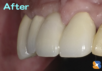 前歯　ブリッジ　保険で高品質