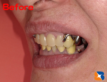 ギラギラ目立つ入れ歯のため、まともに笑えない