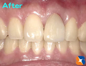 事故発症から７日後にオールセラミックを装着