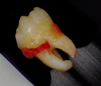 複雑な形をした親知らずの根