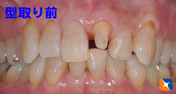 薄く削って、薄いセラミックを入れる