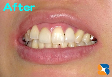 自然な仕上がりセラミック