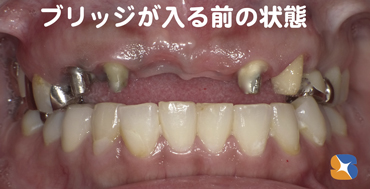 ６連結の前歯のブリッジ　若い女性の将来に関わる