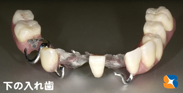 安定感のある薄い入れ歯　見た目も良い