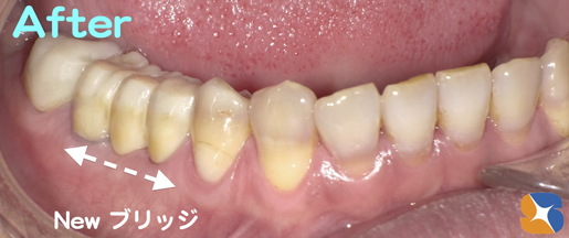 奥歯を半分にして残す　オールセラミック