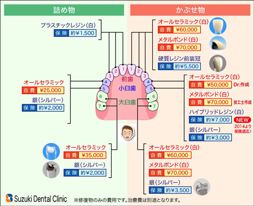 オールセラミック　50,000円〜　安心、安全、保証期間３年