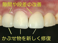 白い歯とホワイトニング