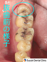 斜めに生えた親知らず