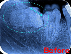 歯と骨に囲まれ出口の狭い親知らず