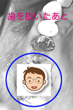 上の奥歯を抜きました。