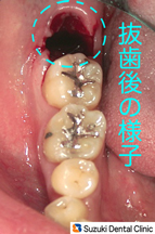 短時間　スムーズな抜歯