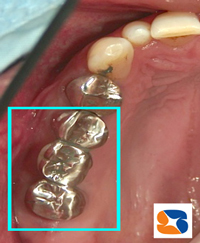 ブリッジを支える移植歯