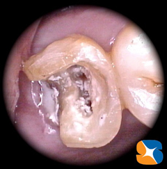 鏡を使わないと見えない神経の治療