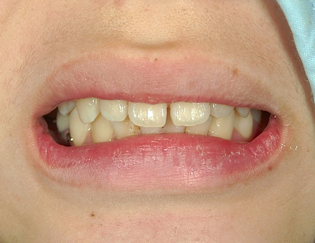 見た目を考慮したミニ入れ歯