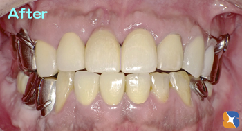 前歯は全て保険のさし歯