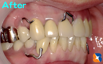 完璧な前歯と入れ歯