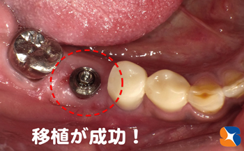 理想的な歯肉に生まれ変わる