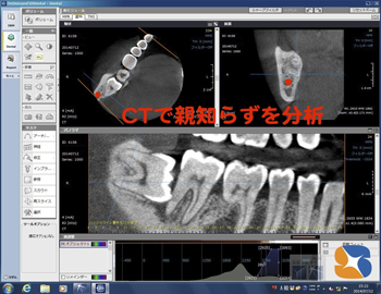 抜歯に欠かせないCT診断