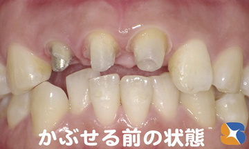 グラつきも治まる　セレックで修復準備