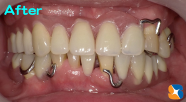 しっかり噛める見た目も良い入れ歯