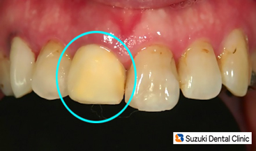 保険の前歯　黄ばむ