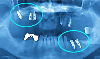 上アゴと下アゴにインプラント手術