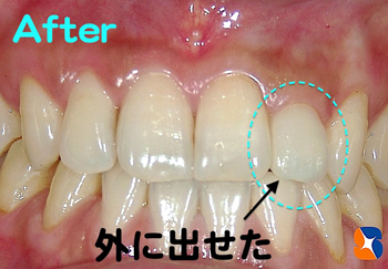 オールセラミックで歯並び改善