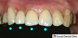 きれいにやりかえた保険のさし歯