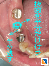  歯を半分にして残す