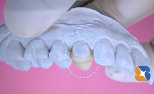 出来上がったセラミックを模型に戻す