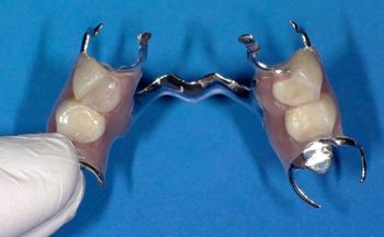 スタッフ一丸で作り上げた渾身の入れ歯