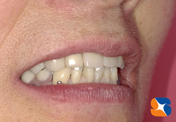 若返り、美しくなった口元