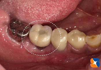 歯ブラシに耐えれるだけのしっかりした歯肉にチェンジ
