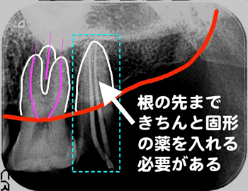 きちんと神経をとり、きちんと薬を詰めるのは至難の技