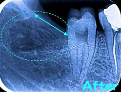出口を広げる手術をしてからの抜歯
