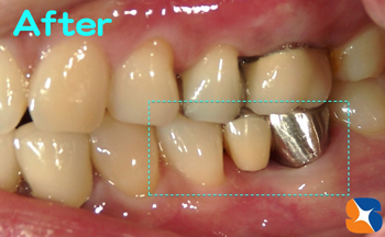 歯を削る本数を最小限