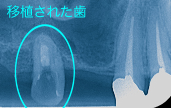 自前でインプラント