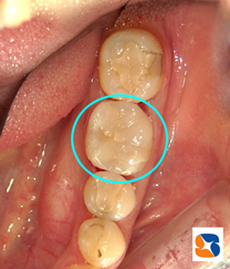 セラミック100％の白い詰め物