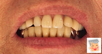入れ歯には見えない入れ歯
