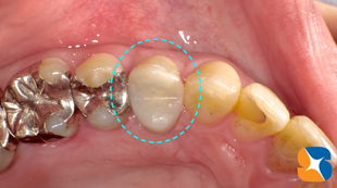 セレックで出来た被せ物を装着