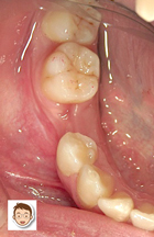 生まれつき歯がはえてこない