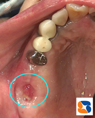 抜歯痕に骨の増強手術