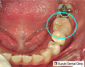 100％セラミック詰め物