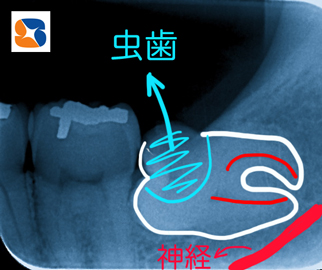 横向きの親知らずが歯茎の中で崩壊