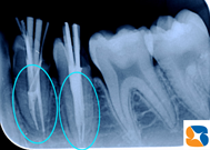神経を抜いた後に薬を詰める