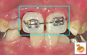 矯正器具を応用して大人の前歯を固定