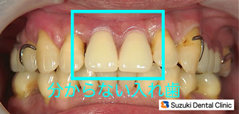 入れ歯にみえない入れ歯